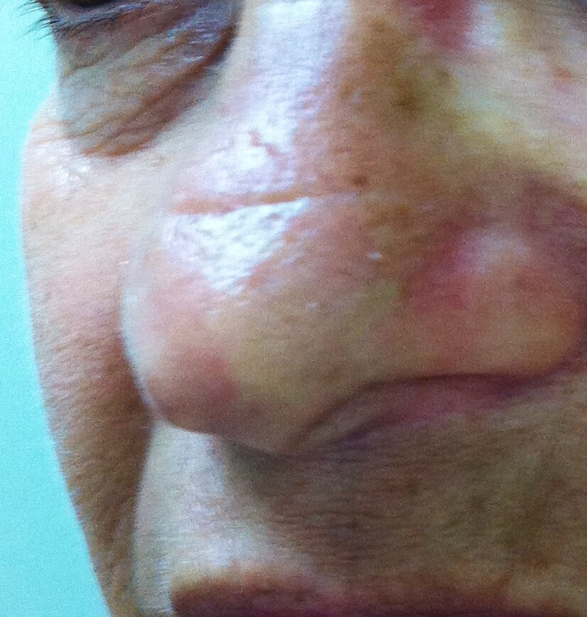 A close-up shot of a patient of Allergy & Immunology Center with swollen nasal tissue due to having a nose allergy. A close-up shot of a patient of Allergy & Immunology Center with swollen nasal tissue due to having a nose allergy.
