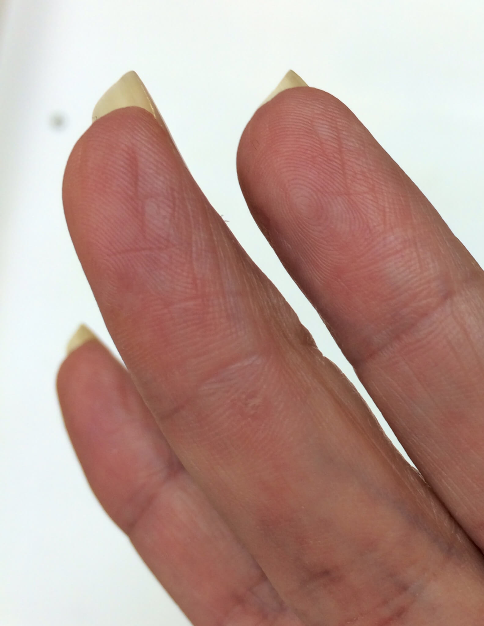 A future patient of Allergy & Immunology Center with photo warts on their fingers. A future patient of Allergy & Immunology Center with photo warts on their fingers.