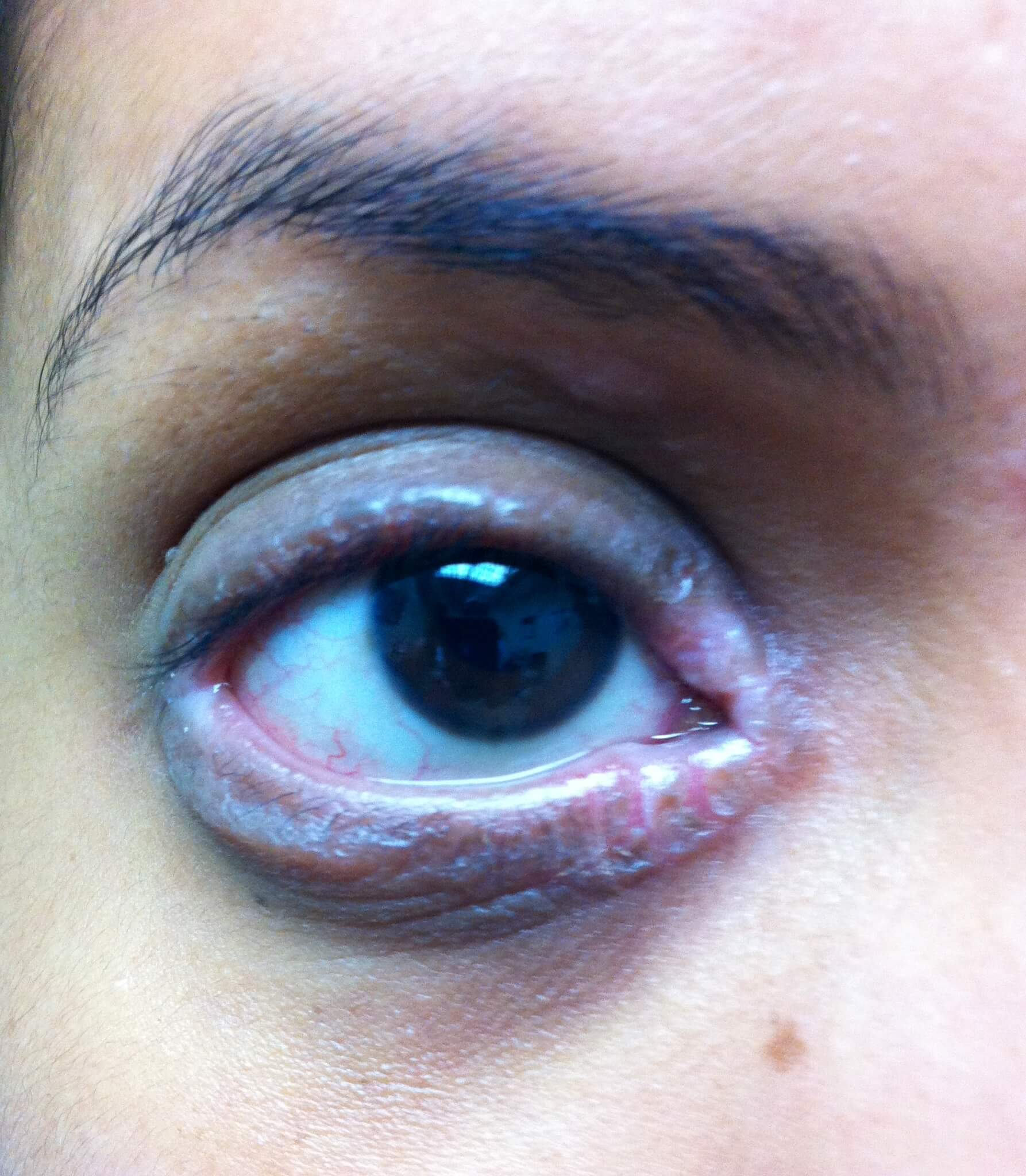 A close-up shot of a patient of Allergy & Immunology Center with a severe case of eye contact dermatitis. A close-up shot of a patient of Allergy & Immunology Center with a severe case of eye contact dermatitis.