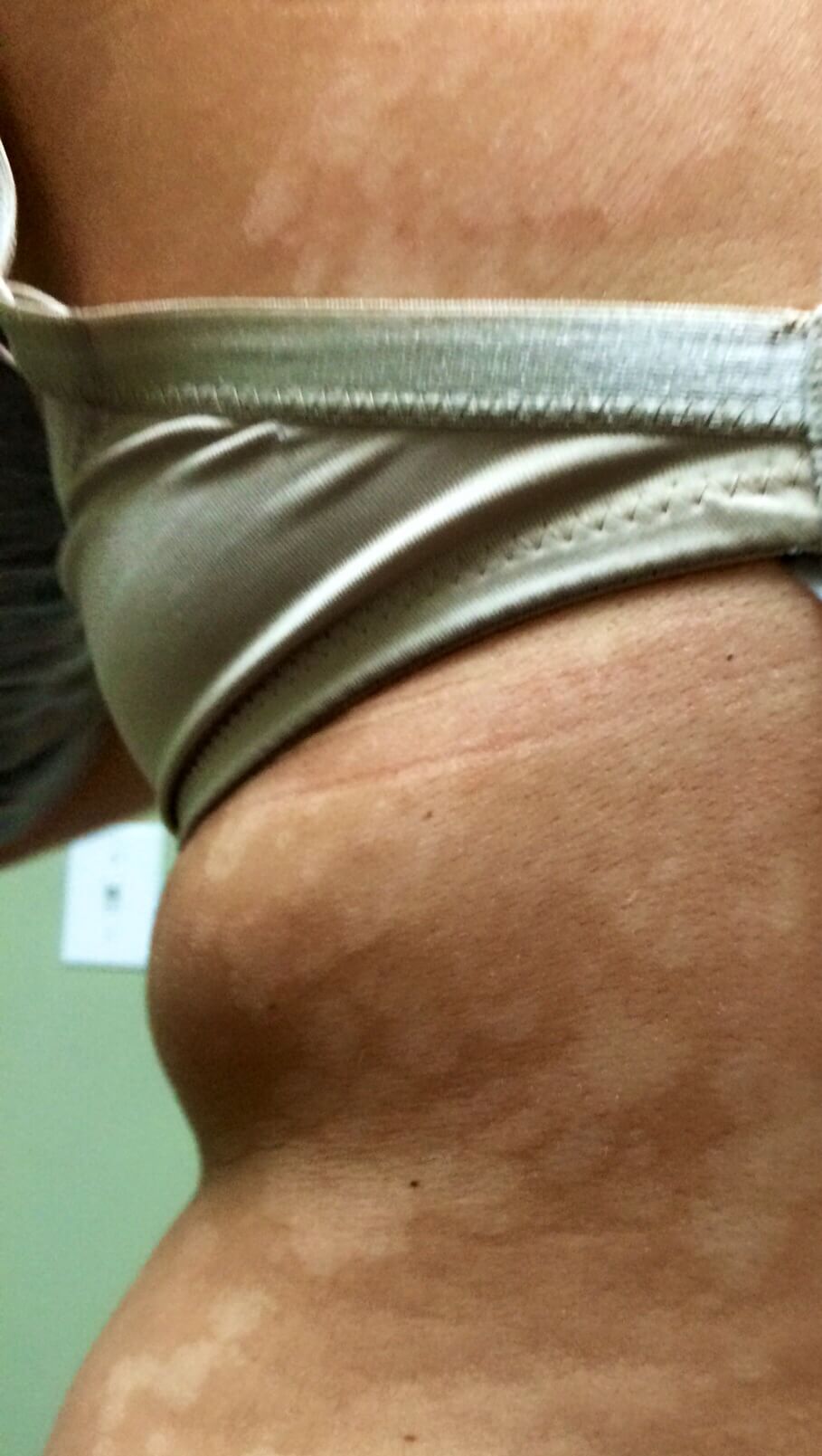 A close-up shot of a patient of Allergy & Immunology Center with sunspots on their body. A close-up shot of a patient of Allergy & Immunology Center with sunspots on their body.