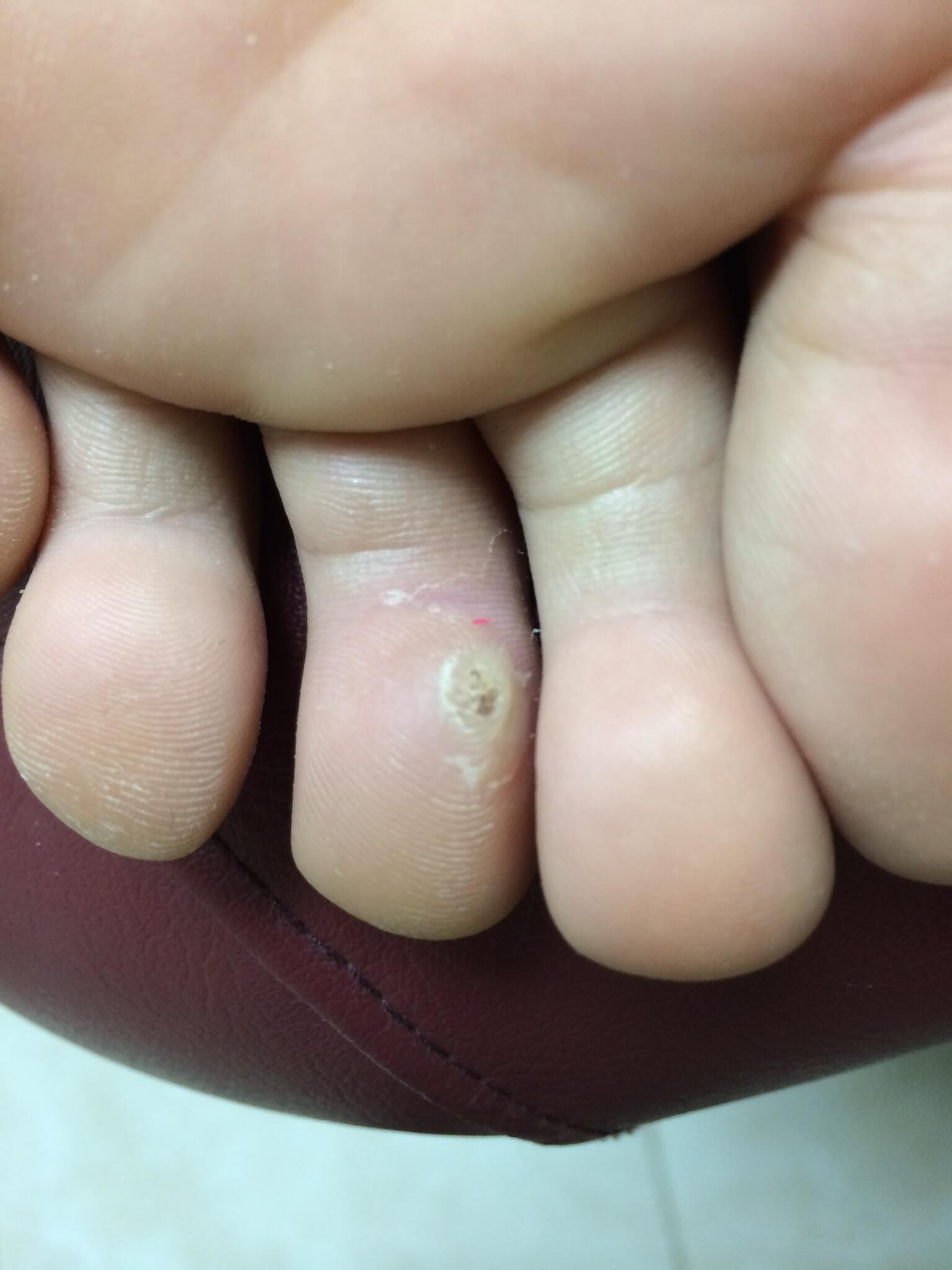 A close-up shot of a future patient of Allergy & Immunology Center with a wart on their toe. A close-up shot of a future patient of Allergy & Immunology Center with a wart on their toe.
