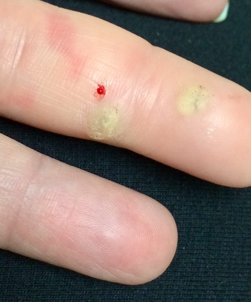 A close-up shot of a future patient of Allergy & Immunology Center with warts on their fingers. A close-up shot of a future patient of Allergy & Immunology Center with warts on their fingers.