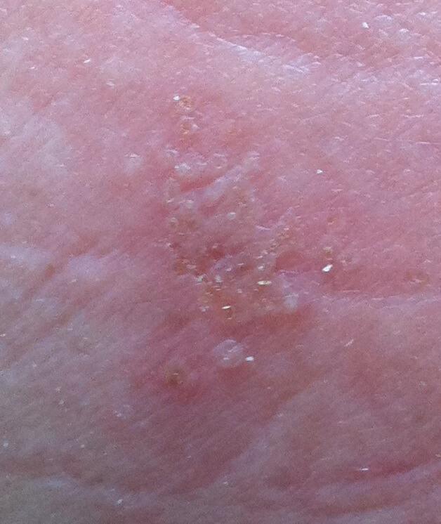 A close-up shot of a patient of Allergy & Immunology Center with a zoster rash. A close-up shot of a patient of Allergy & Immunology Center with a zoster rash.