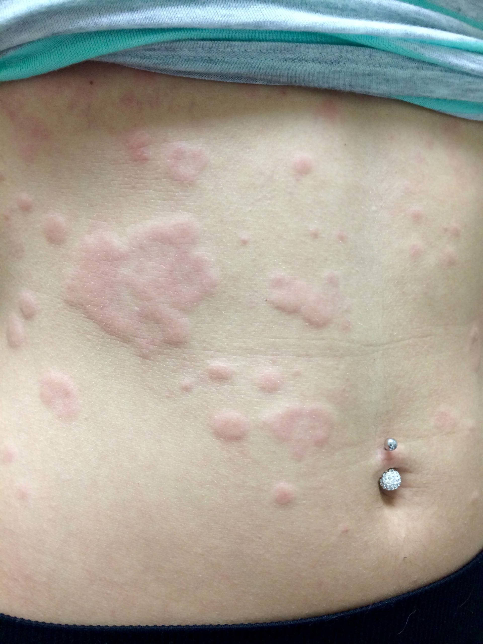 A female patient of Allergy & Immunology Center with hives on her stomach. A female patient of Allergy & Immunology Center with hives on her stomach.
