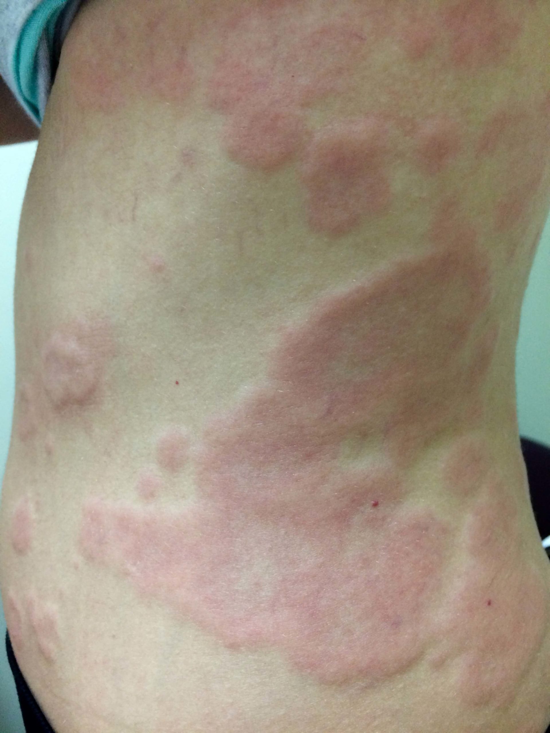 A patient of Allergy & Immunology Center with hives on the side of their body. A patient of Allergy & Immunology Center with hives on the side of their body.