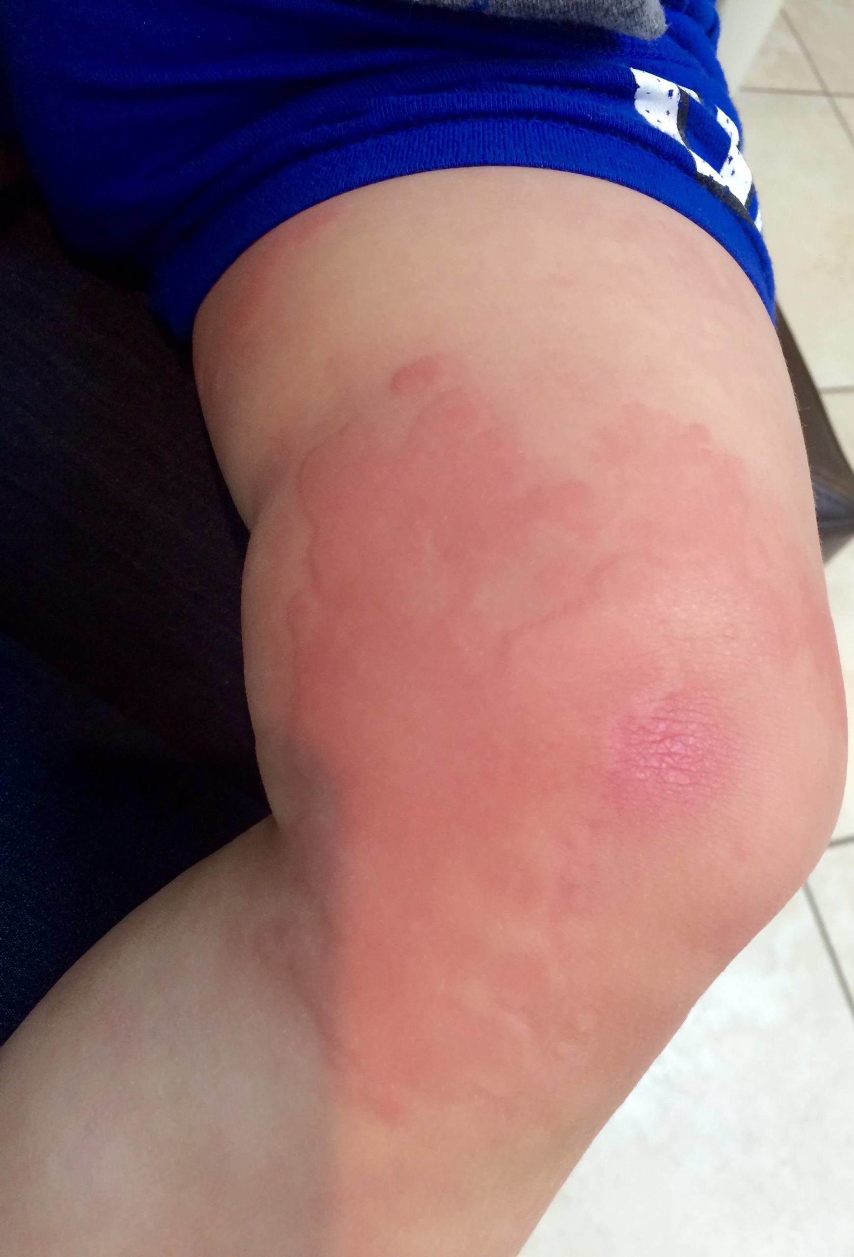 A future child patient of Allergy & Immunology Center with hives on his knees. A future child patient of Allergy & Immunology Center with hives on his knees.