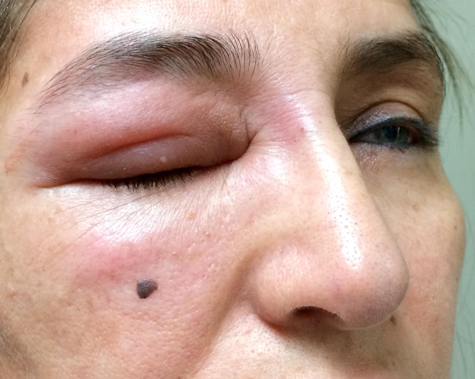 A female patient of Allergy & Immunology Center who is suffering from a swollen eyelid due to having some form of a skin allergy. A female patient of Allergy & Immunology Center who is suffering from a swollen eyelid due to having some form of a skin allergy.