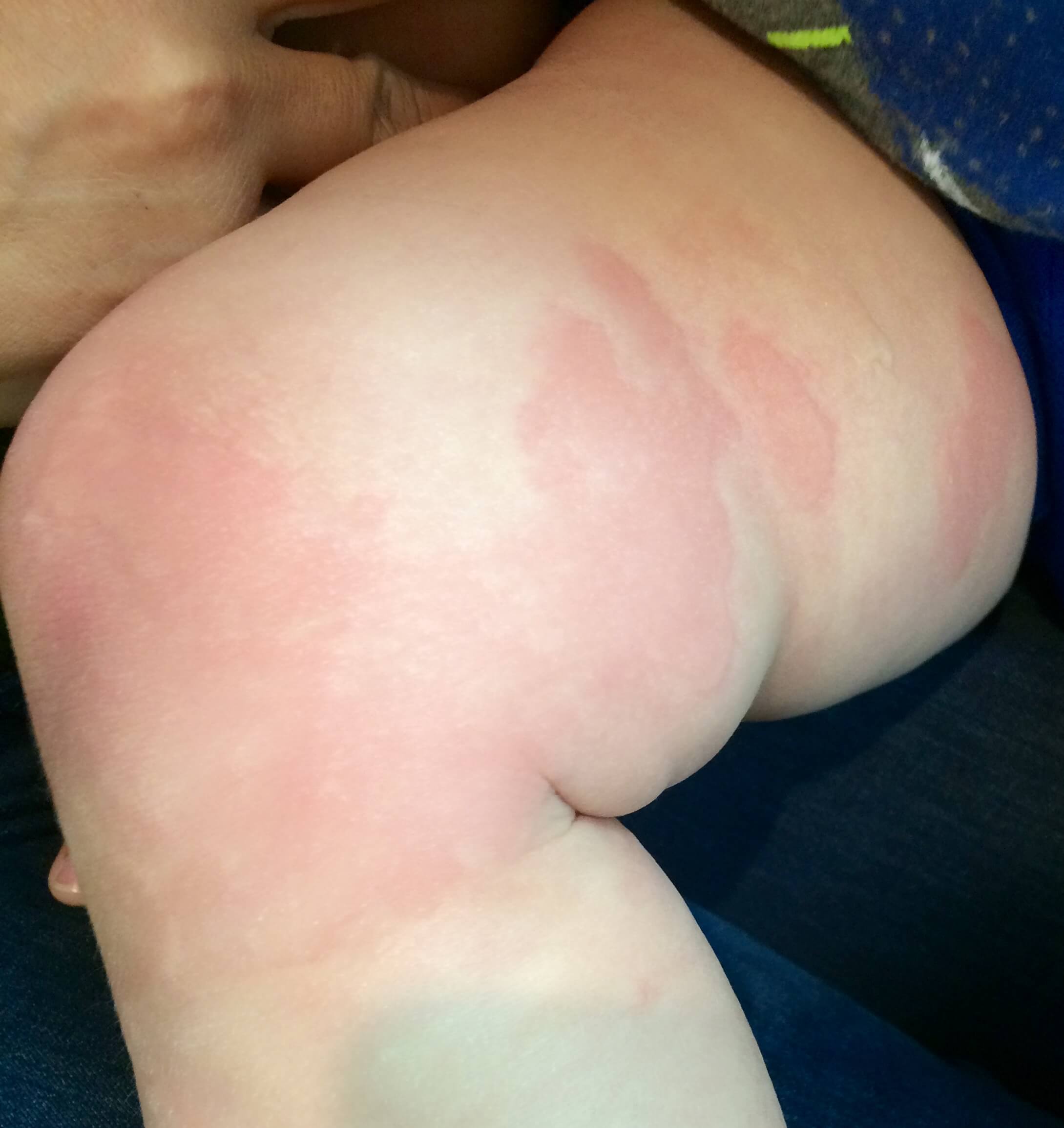 An infant patient of Allergy & Immunology Center with hives on their legs. An infant patient of Allergy & Immunology Center with hives on their legs.