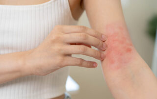 Dermatology, asian young woman, girl hand in her arm allergy, allergic reaction from atopic, insect bites, hand in scratching itchy, itch red spot or rash of skin. Beauty problem by medical treatment.