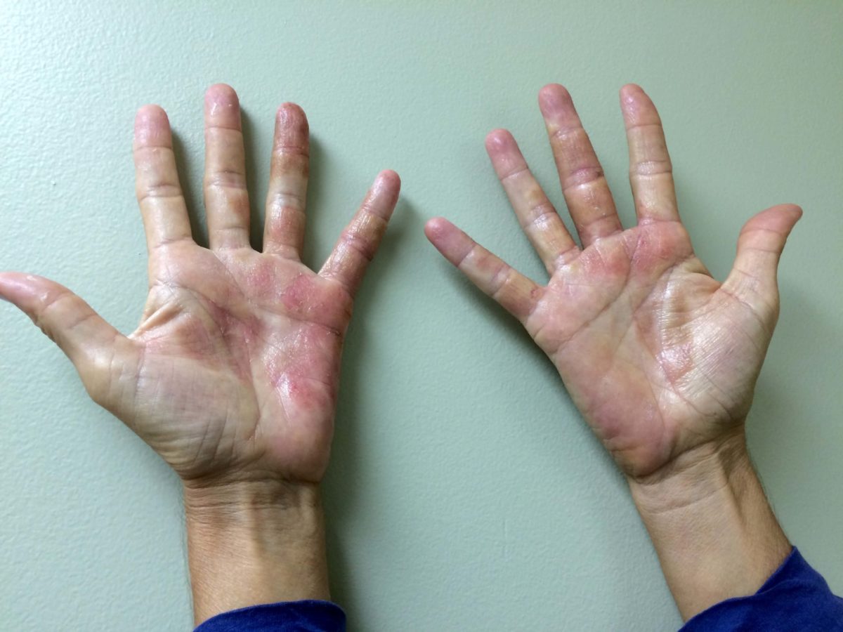 Eczema Treatment In Miami, Florida | Allergy & Immunology Center
