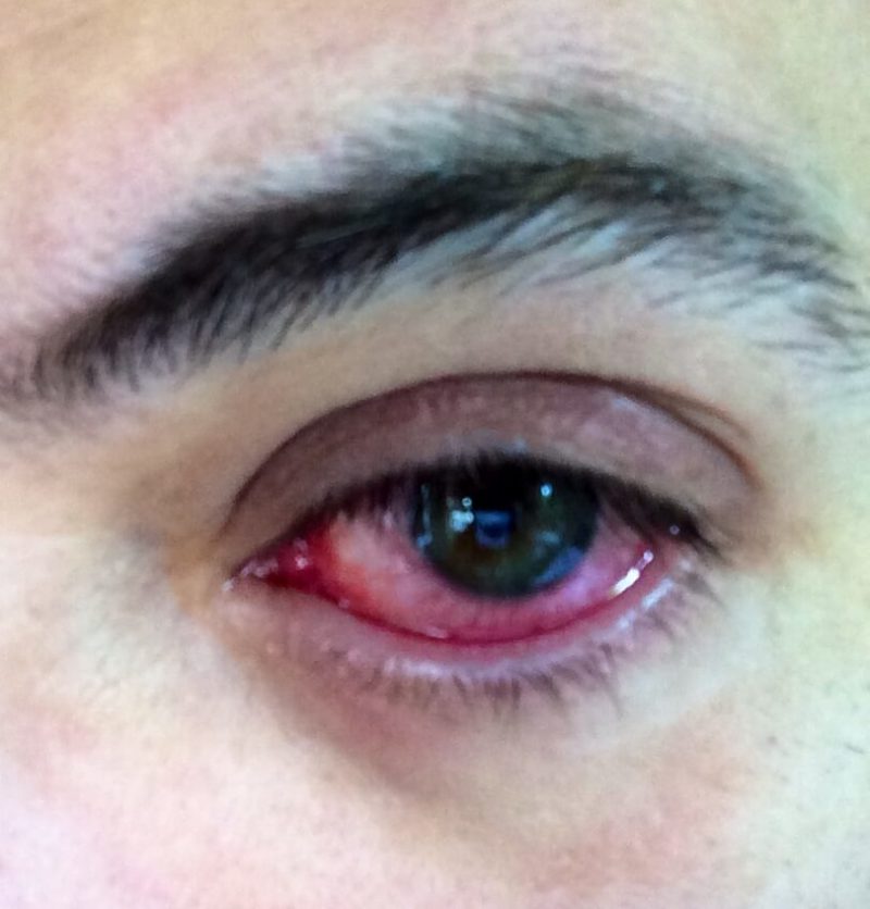 Eye Allergy Consultation In Miami, FL Allergy & Immunology Center