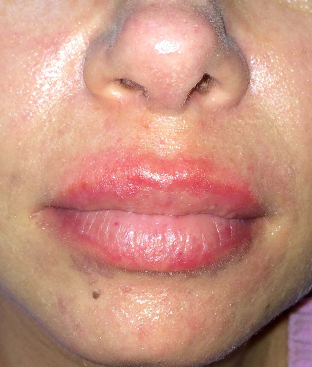 Lips contact allergy immunology center