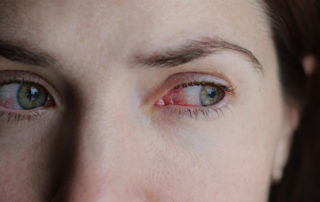 Closeup of Irritated or Infected Red Bloodshot Eye - Conjunctivitis