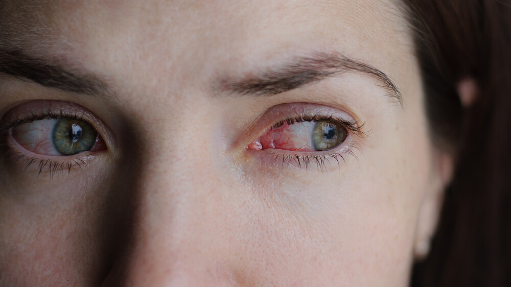 Closeup of Irritated or Infected Red Bloodshot Eye - Conjunctivitis