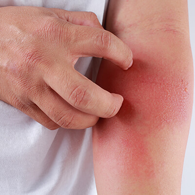 Atopic Dermatitis Symptoms
