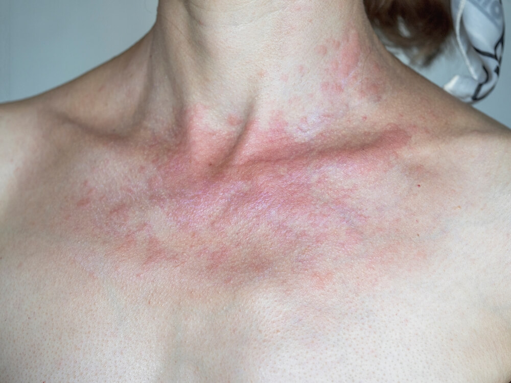 Solar Dermatitis. Woman With Red Sunburned Skin Against Gray Background