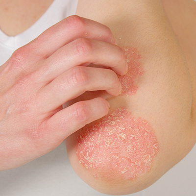 Skin Allergy Symptoms