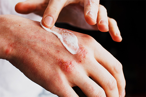 Skin Allergy Treatment 600×400 | Allergy & Immunology Center