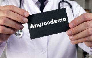 Medical Concept Meaning Angioedema With Sign on the Sheet.
