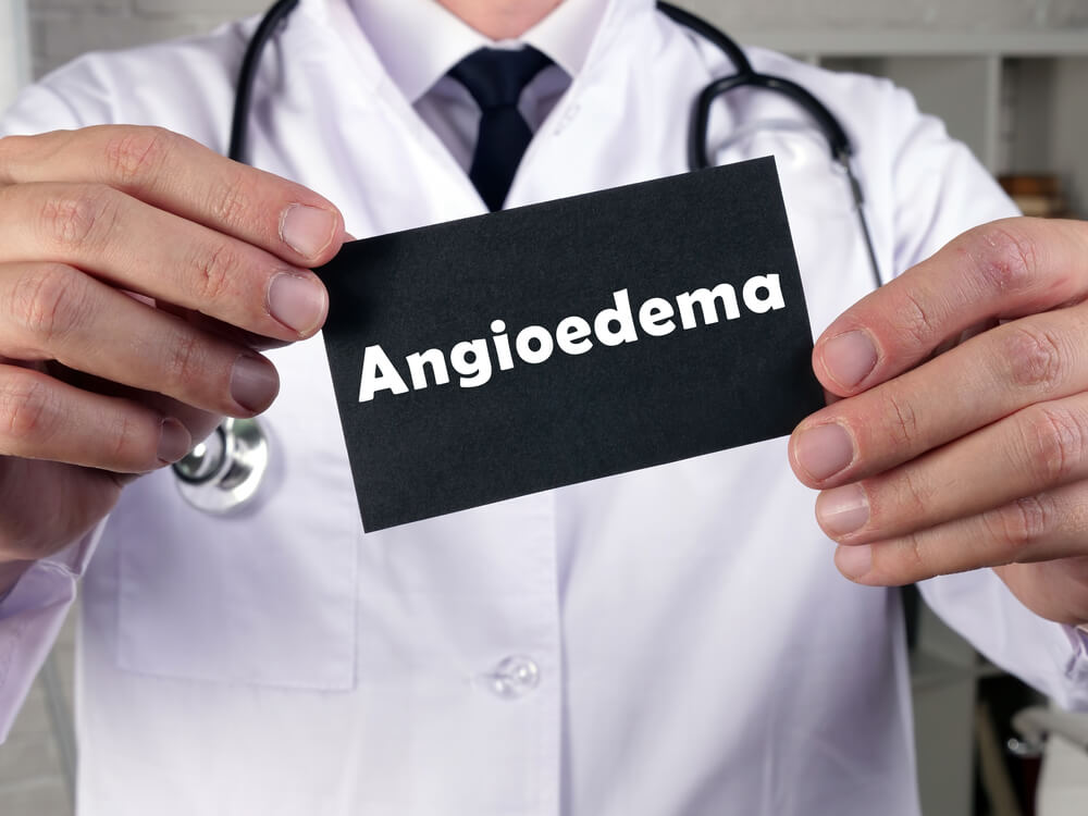 Medical Concept Meaning Angioedema With Sign on the Sheet.