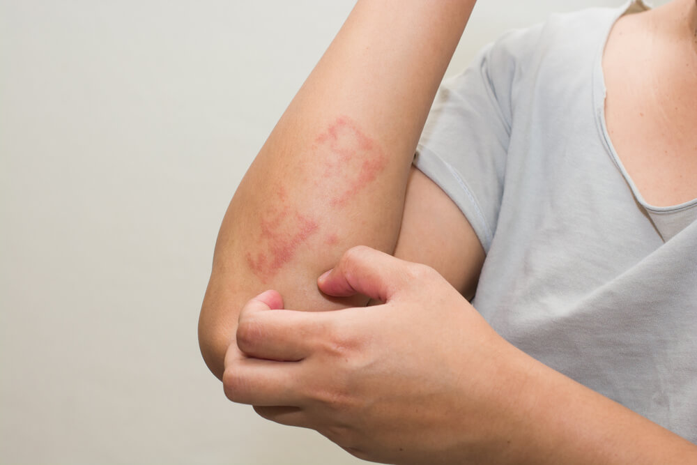 Allergic Rash Dermatitis Eczema Skin of Patient