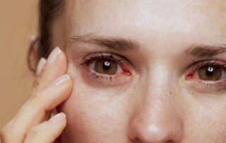 Closeup on Young Woman With Inflamed Eyes