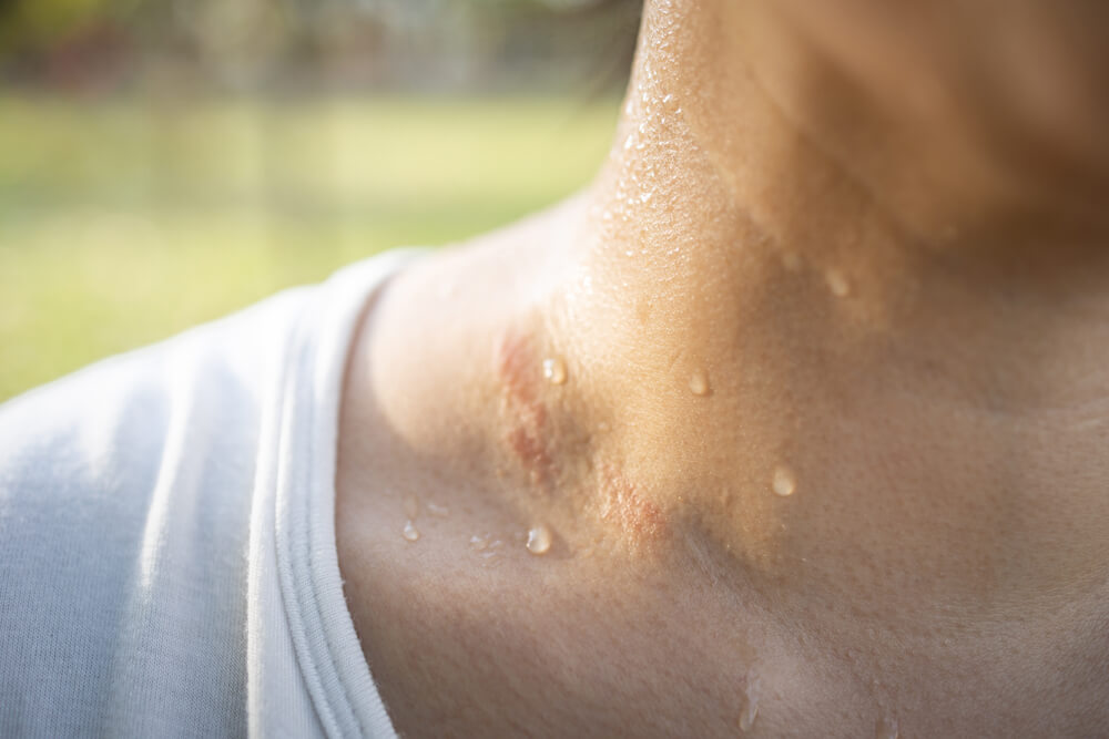 Closeup of Wet Female Throat With Water Drops or Sweat on Skin,Symptom of Panic Disorder, Lymphoma or Obesity