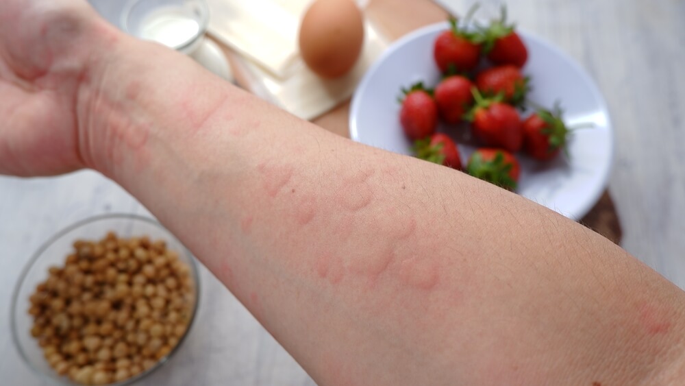 Close Up Image of Arm Suffering Severe Urticaria or Hives or Kaligata With Illustration of Allergy Trigger Foods