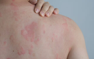 Close Up Image of Skin Texture Suffering Severe Urticaria or Hives or Kaligata on Back