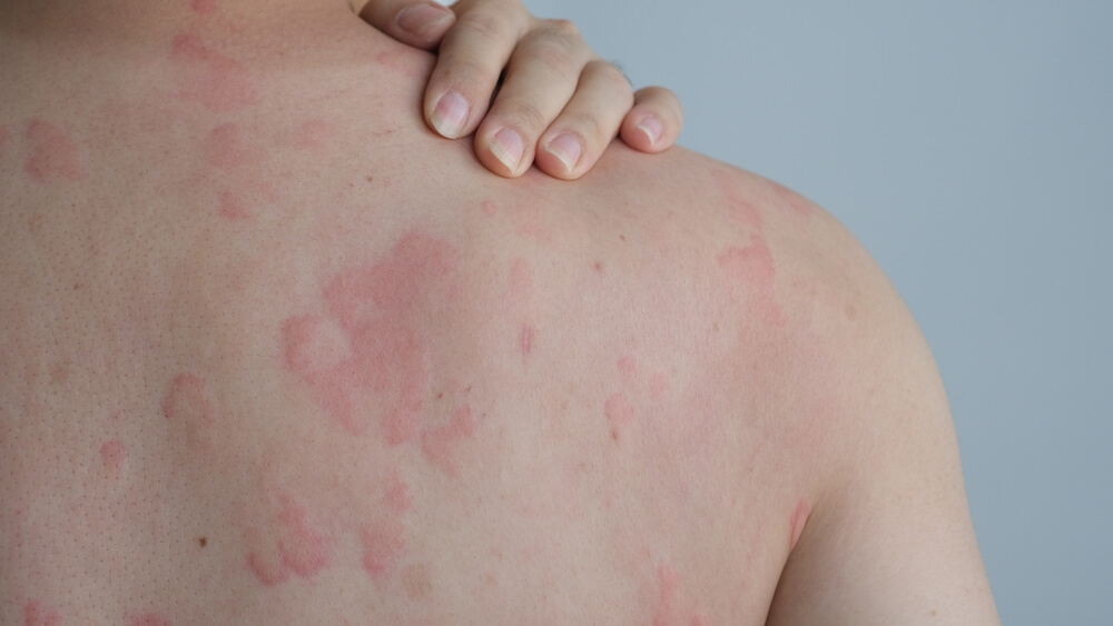 Close Up Image of Skin Texture Suffering Severe Urticaria or Hives or Kaligata on Back