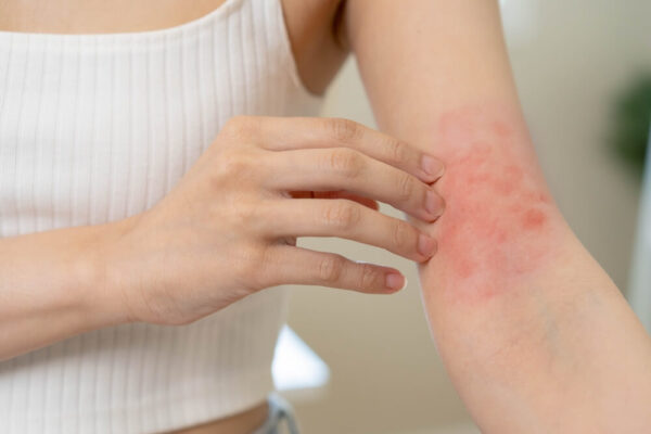 how to get rid of allergy rash at home