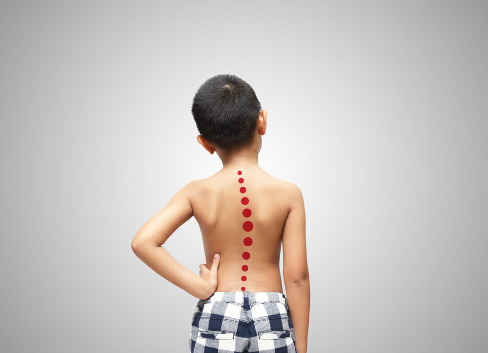 Asian Kid With Scoliosis, Isolated on White Background