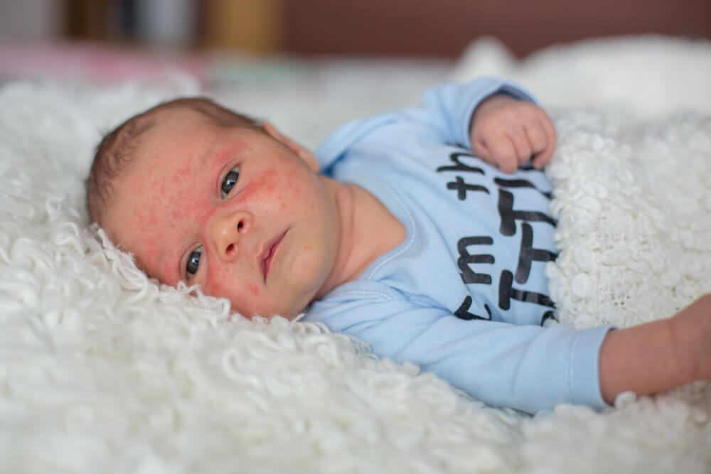 Baby With Skin Rash