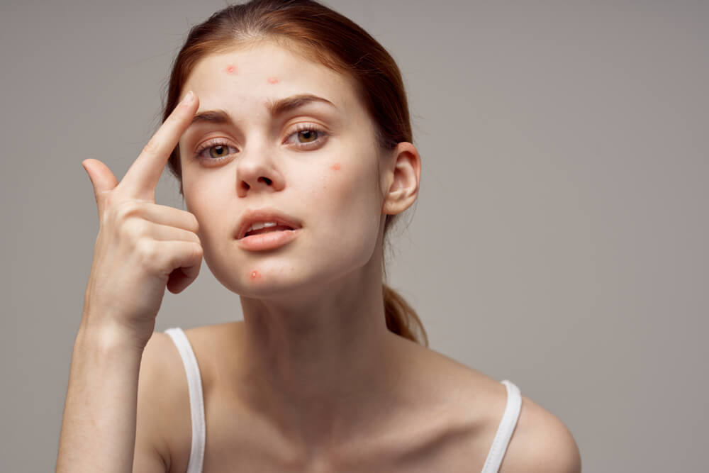 Beautiful Young Woman in a White T-Shirt Shows a Finger on the Red Acne on Her Face