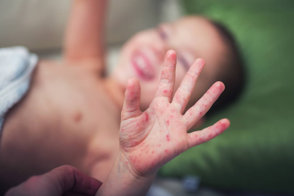 Boy With Symptoms Hand, Foot And Mouth Disease