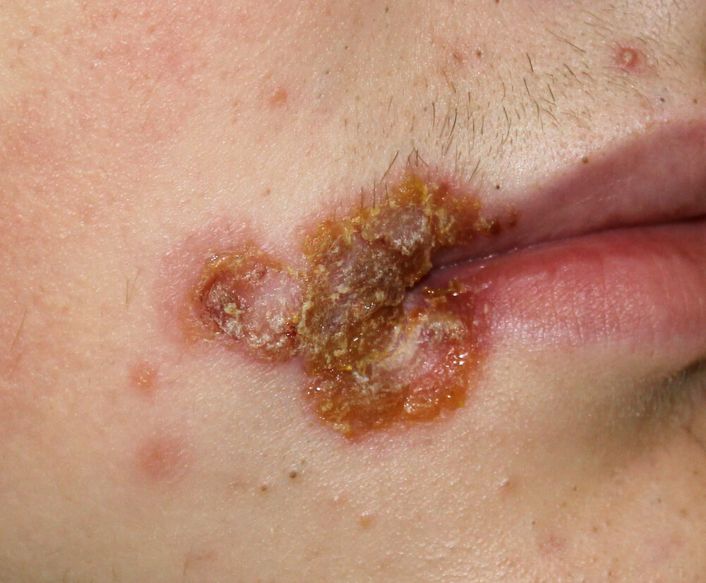 A Case Of Streptococcal Impetigo In A Male