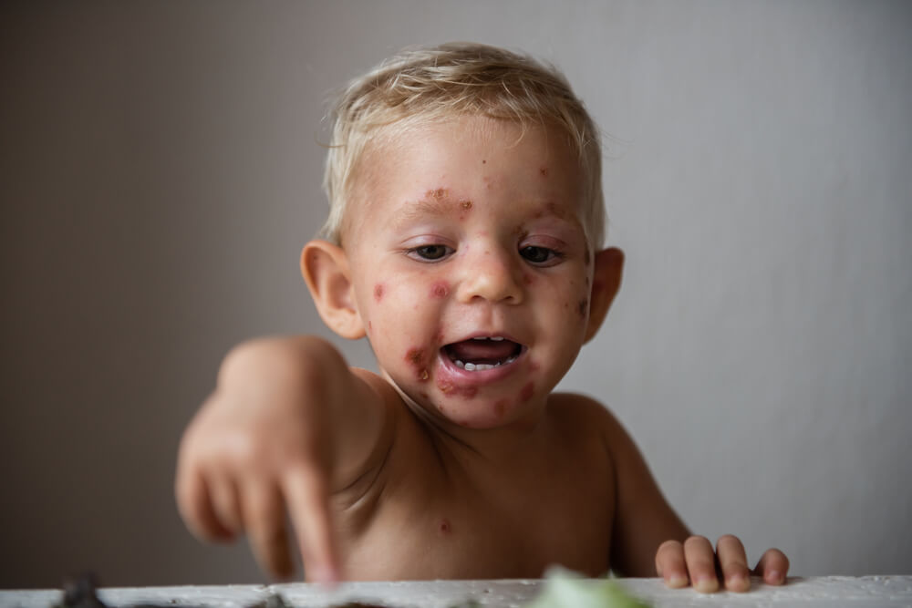 Little Baby With Rash On The Skin Of The Face