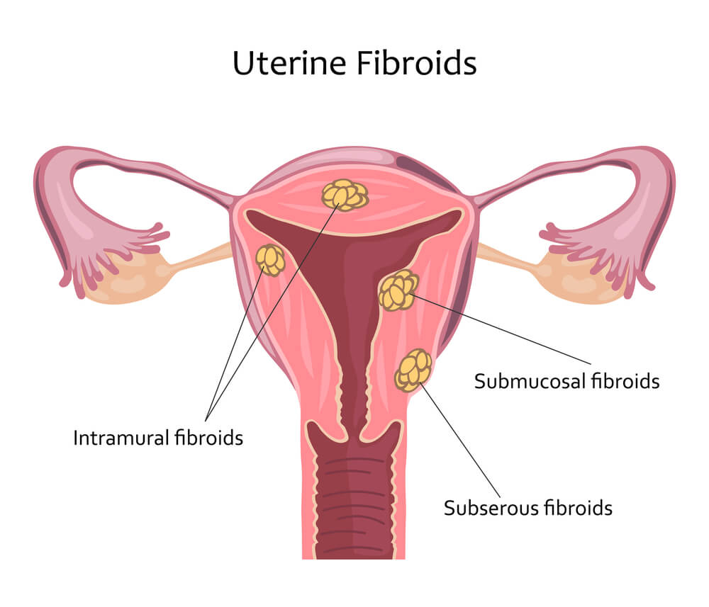 What Is a Uterine Fibroid