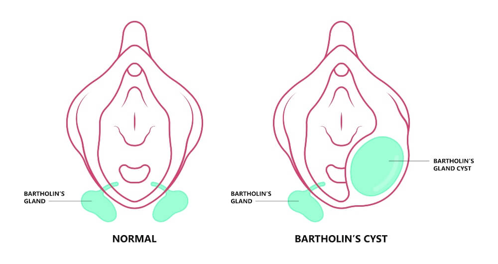 Bartholin’s Cyst Vagina Pain Lump Mass