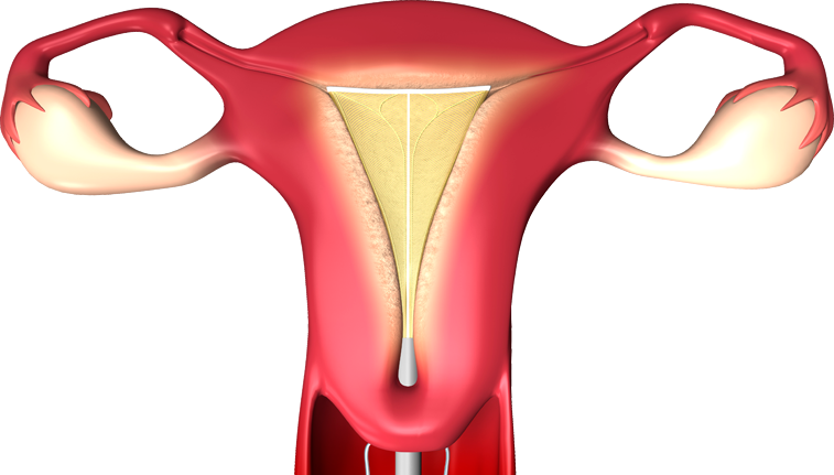 novasure procedure