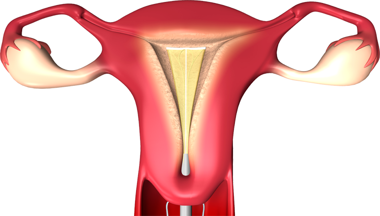 novasure procedure