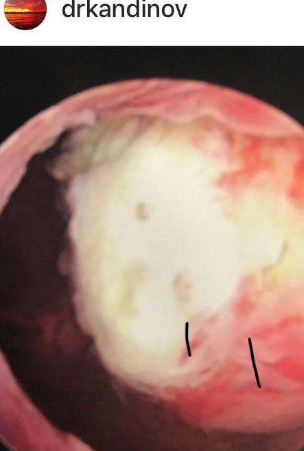 hysteroscopic myomectomy