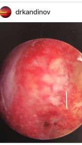 hysteroscopic