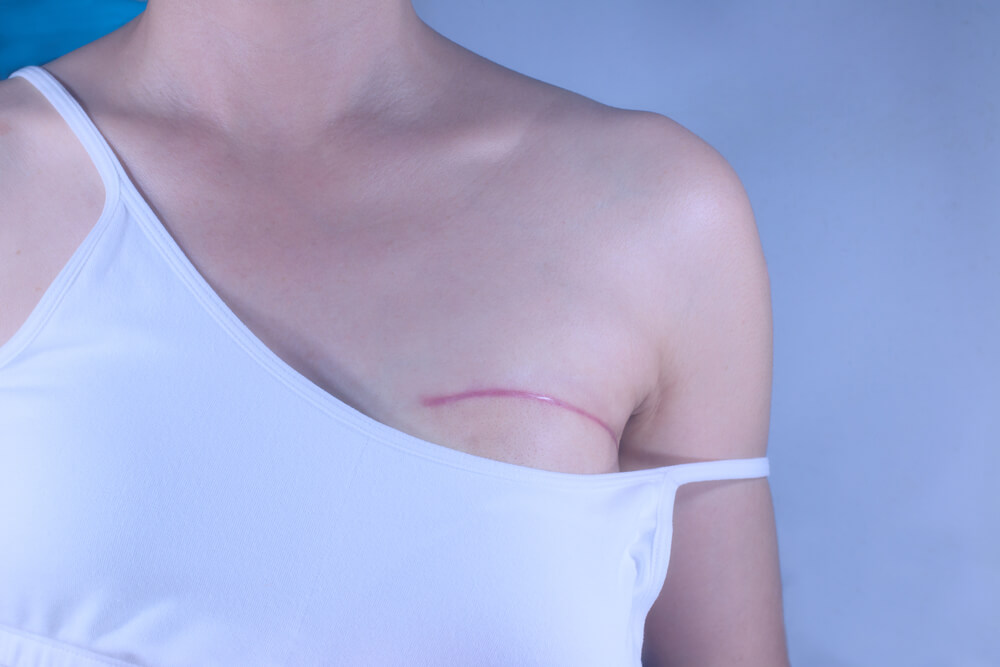 Woman With Breast Cancer Surgery Scars by Partial Mastectomy. 