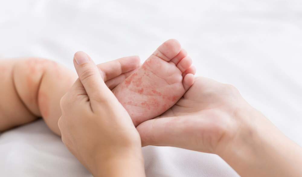 Measles virus. Mother holding tiny baby foot with red rash, closeup