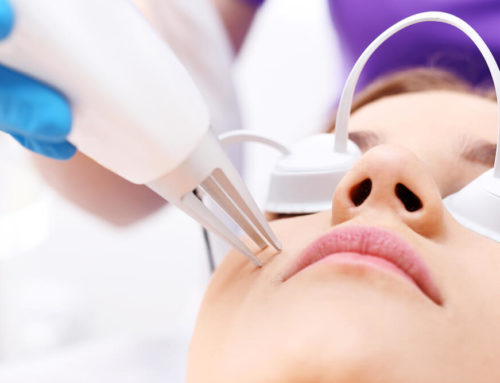 Everything You Should Know About Acne Scar Laser Treatment