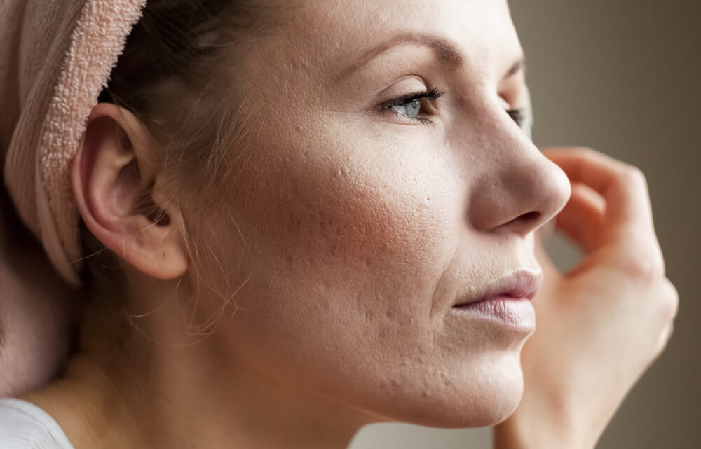 Woman with acne scars