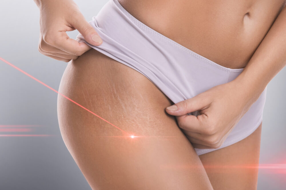 Do You Need Stretch Mark Removal