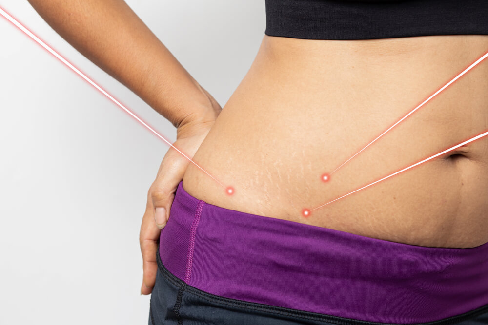 Laser Stretch Mark Surgery