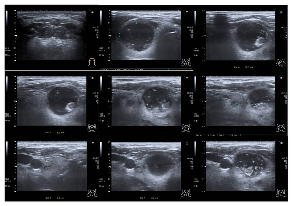 Ultrasound of the Thyroid
